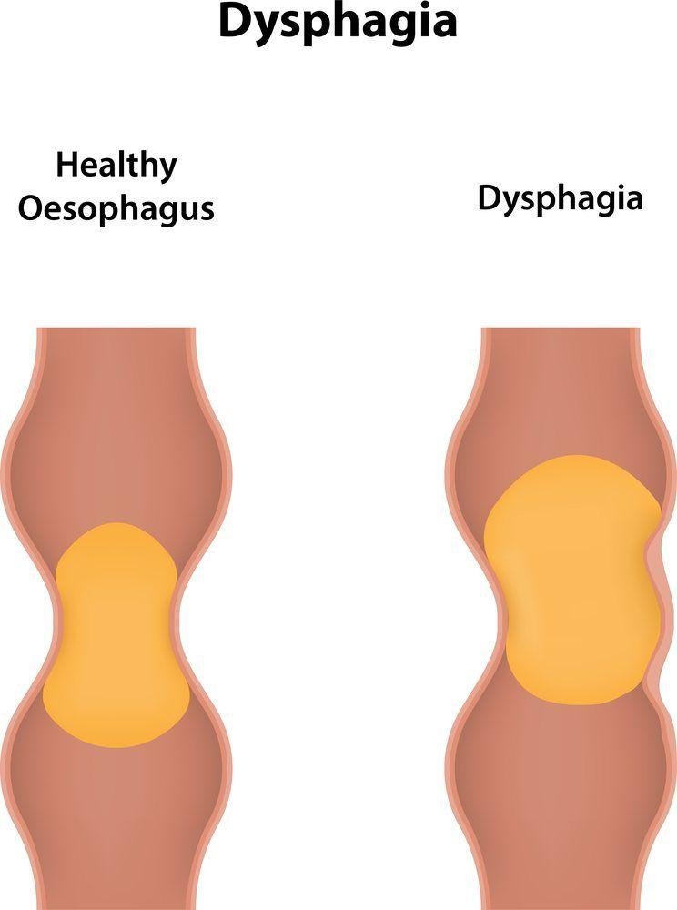 Opciones nutritivas para ‍un menú ⁢adaptado a la disfagia